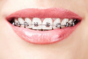 Dental-Braces-1vn