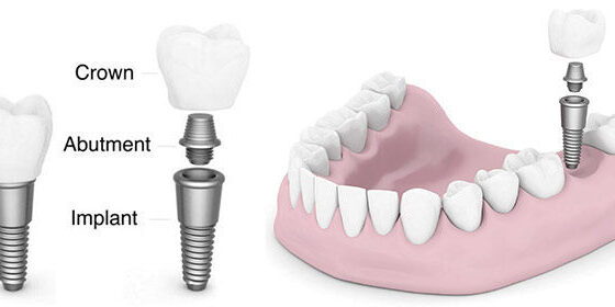 Dental-Implant 1